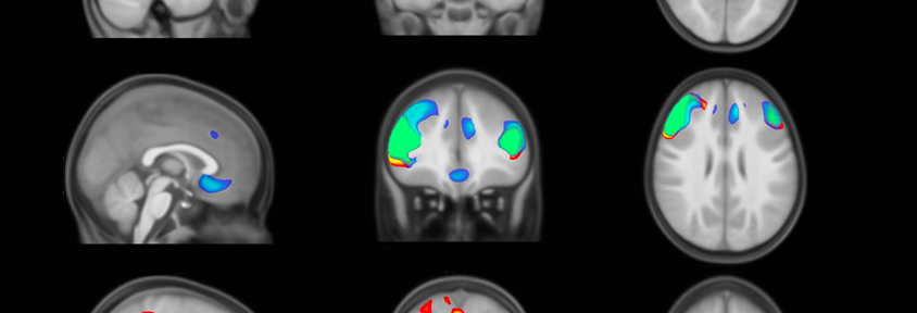 Differences in brain networks in 3-year-old autistic children