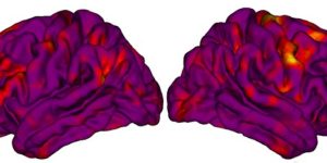 Brain viewed from 2 sides. The brain is shaded dark purple with red and yellow highlights in certain regions.