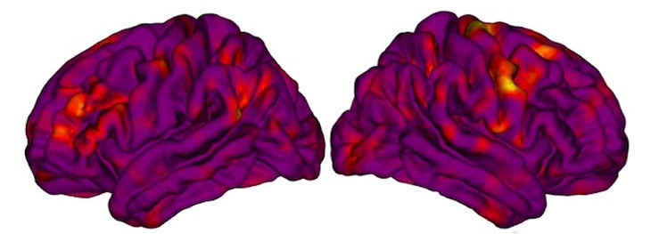 Sex differences in trajectories of cortical development in autistic children from 2–13 years of age